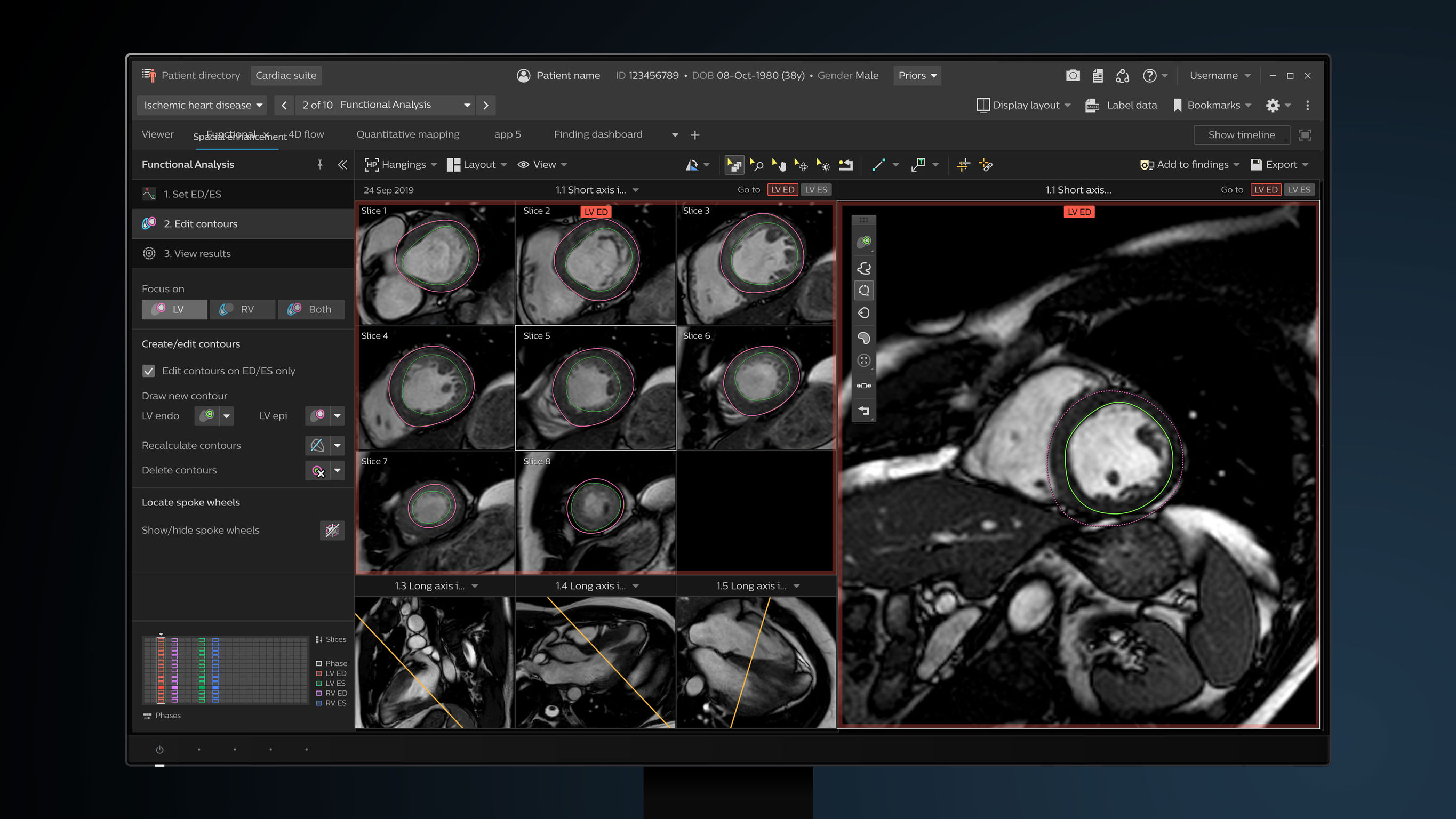 IF Design - Philips IntelliSpace Portal Cardiac MR Suite